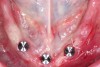 Transitioning to healing abutments