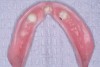 The denture was relieved in the area where the housing attachments were located.