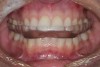 (1.) This SRS was fabricated for wear on the maxillary arch. The anterior contour allows the posterior teeth to separate in lateral and protrusive movements.