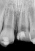 Fig 2. Age 8. Radiograph of teeth Nos. 8 and 9 at initial examination.