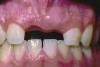 Fig 5. Age 15. Facial view of the developing ridge after removal of coronal segment of tooth No. 8.