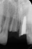 Fig 7. Age 15. Radiograph of teeth Nos. 8 and 9. The apices of the retained roots remained in a position similar to the apices of the adjacent teeth as did the coronal edges of the roots relative to the CEJ.