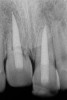 Fig 15. Age 14. Radiograph revealed extensive replacement resorption of tooth No. 8.