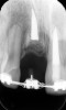 Fig 17. Radiograph of No. 8, 1 year after decoronation. Note the bone coronal to the residual spicules of resorbing root.