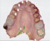 Fig 5. New intraoral scans capture the surfaces of the provisional crowns with the teeth in occlusion to create a virtual articulator; additional scans of the preparation dictate the digital impression.