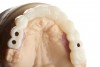Fig 10. The same file was then sent for milling or 3D printing to create the full-arch provisional restoration.