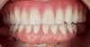 Fig 13. A patient presenting with an edentulous mandible and previously opting for All-on-4 surgical implant placement arrived for a final impression appointment adequately healed and wearing a satisfactory conversion prosthesis.