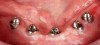 Fig 14. All implants were osseointegrated with no clinical movement, mucosal tissue was uninflamed and healthy, all abutments were firmly connected to the implants, and the patient was comfortable and well-satisfied with the esthetics.