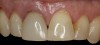 4. Facial and occlusal views of initial clinical presentation of tooth No. 8.