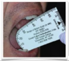 Fig 3. A maximum unassisted mouth opening of 45 to 60 mm.