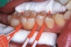 Fig 3. Three thin soft dental picks were used simultaneously for SDF proximal surface saturations in a teenaged patient (Fig 3). After 60 seconds, the treated regions were covered with 5% fluoride varnish (Fig 4). A comparison can be seen of pre-SDF-treatment bitewing films (Fig 5) and 8-month post-SDF bitewing films (Fig 6) for the patient shown in Fig 3 and Fig 4. Radiolucencies were similar or improved, except for contact of maxillary first and second molars.
