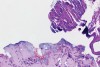 Laser biopsies causing tissue cauterization and artifactual separation of the epithelium from the connective tissue (810 nm, 1 W, continuous wave).