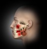 Fig 1. Masseter attachment trigger points near the upper musculotendinous junction of superficial layer and central trigger points of superficial layer with referred pain patterns to lower jaw, teeth, and gingival area.