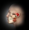 Fig 3. Masseter trigger points of the upper posterior deep layer below TMJ with referred pain patterns to ear area.