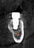 (13.) Postoperative CBCT image of actual implant placement at site No. 19.