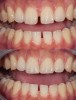 (6.) Preoperative and postoperative images of a maxillary central diastema that was closed without the use of orthodontics.