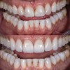 (8.) Before and after photographs with almost identical widths in the incisal one-third, but the added height to the teeth in the postoperative photograph makes them appear narrower.