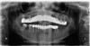 Fig 7. Preoperative panoramic radiograph. Note decay of supporting teeth.