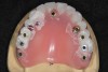 Fig 11. Immediate provisional “pick-up” of preoperatively fabricated denture.