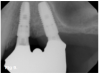 Fig 9. Tilted implant solutions for maxillary posterior partial edentulism. In the same manner that tilted implants can be used to
avoid the need for sinus grafting in full-arch implant prostheses, they can be used to avoid direct or indirect sinus grafting when insufficient posterior
maxillary bone volume challenges a fixed dental prosthesis implant restoration. Fig 7: Software planning for implant placement is shown with
tilting of the distal implant along the anterior wall of the maxillary sinus where there is insufficient bone in zone 3. Fig 8: Postoperative radiograph
of the implants and abutments reveals the angulation of the implant resolved by the CAD/CAM abutment. Fig 9: Final radiograph of the implant
prosthesis following restorations demonstrates the inclusion of a tooth in the molar position without sinus grafting.