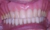 Figure 1  Preoperative photograph of existing upper and lower dentures. Only the upper was to be fabricated.