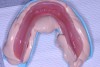 Figure 2  AlgiNot impression of existing lower denture.
