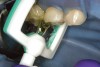 Figure 10  Icon Infiltrant flowing through matrix channel into contact area on mesial of tooth A.