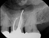 Fig 2. Tooth No. 14 was treated with silver points. In Figure 2, tooth No. 18 with mesial canals treated with Sargenti paste. The hallmark radiographic appearance of this technique is the light radiopacity within the canal system, as in Figure 3.