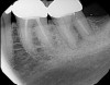 Fig 3. Tooth No. 14 was treated with silver points. In Figure 2, tooth No. 18 with mesial canals treated with Sargenti paste. The hallmark radiographic appearance of this technique is the light radiopacity within the canal system, as in Figure 3.