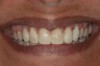 Fig 9. Smile view with provisional facial veneers.