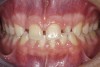 (1.) Initial presentation. Note midline shift to right, missing right lateral incisor, and diminutive left lateral incisor in crossbite.