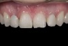 (7.) Resin-bonded bridge after removal, implant placement, and bridge recementation.