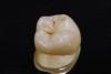 (1.) Monolithic zirconia crown with superficial staining.