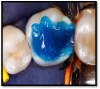Fig 3. Total etch (etch and rinse): maximum adhesion to both enamel and dentin with optimum marginal integrity.