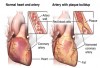 Fig 1. Coronary heart disease (source: Johns Hopkins).