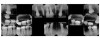 Fig 15. Case 3 full-mouth x-rays.