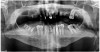 Figure 2: These re-operative panoramic radiograph.