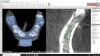Figure 4: Screen capture of a mandibular virtual implant treatment plan shows digital denture design that includes the positioning handle and occlusal locks.