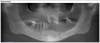 Figure 15: A pre-operative panoramic radiograph reveals several issues.