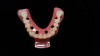Figure 6: Occlusal view of a mandibular monolithic conversion denture shows the positioning handle, occlusal locks, implant access holes, and perforated borders.