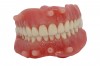 Figure 18: Both maxillary and mandibular SurgiDentures in static occlusion feature occlusal locks, which are also seen in the occlusal view of the mandibular SurgiDenture.