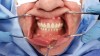 Figure 20: Maxillary and mandibular SurgiDentures are fully seated following extractions.