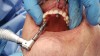 Figure 21: The implant coated with PRP is ready for placement through the maxillary SurgiDenture.