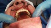 Figure 23: Autopolymerizing resin is added to pick-up temporary copings, as seen in the occlusal view of maxillary SurgiDenture.
