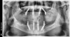 Figure 26: The patient’s final panoramic radiograph shows all surgical placement.