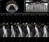 Fig 14 and Fig 15. SFOT performed on buccal bone, preoperative (Fig 14) and postoperative (Fig 15) CBCT scans. Note the facial thickness added at the apical third despite the proclination of the decompensated mandibular incisors.