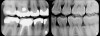 Fig 1. Left: Representative PSP BW radiograph with multiple restorative materials of varying radiographic densities. Tooth No. 31 demonstrates deep
caries on mesial aspect beneath the restorative. Radiolucency of carious lesion results from the low relative density of caries compared with healthy
tooth structure. Right: PSP BW radiograph optimized for view of multiple interproximal carious lesions.