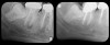 Fig 12. A PSP PA demonstrating
poor quality endodontic treatment on left, associated with tooth No. 31,
resulting in PA pathosis. Retreatment of root canal and replacement of
restoration on this tooth is subsequently followed periodically, as in the PA
on the right side, exposed 7 years later.