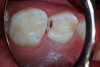 (7.) After exposure of disto-occlusal caries, SDF is applied, followed by a coating of fluoride varnish.