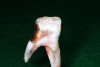 (12.) Views of sectioned primary molar that was extracted for orthodontic considerations 22 months after three SDF treatments that were each 6 months apart.